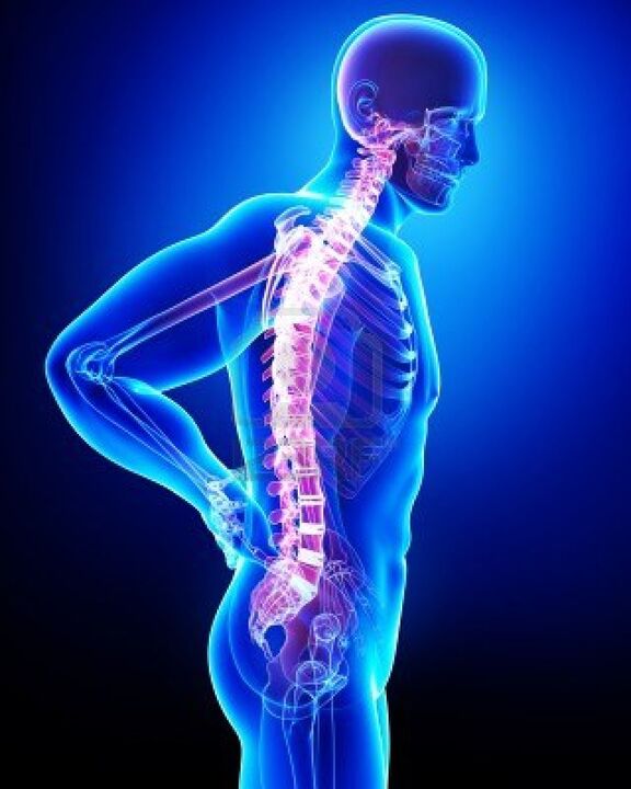 Žmogaus stuburas pažeistas osteochondrozės